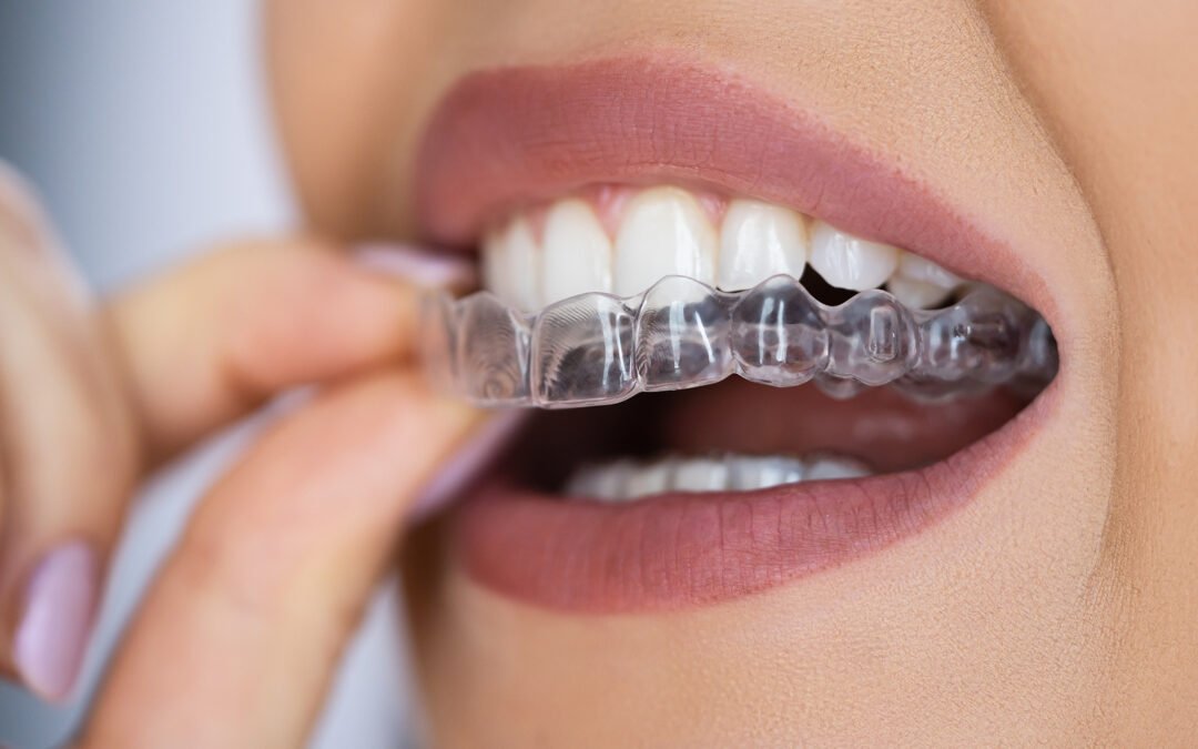 Dental Aligners